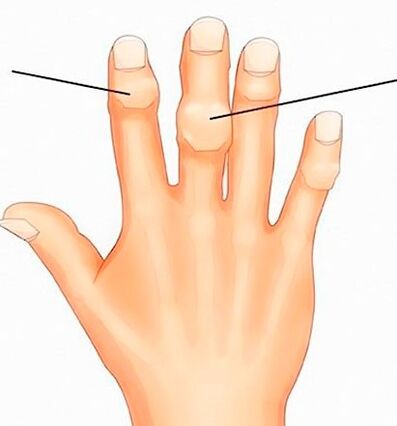 Nódulos de Heberden e Bouchard nas articulações interfalângicas com artrose