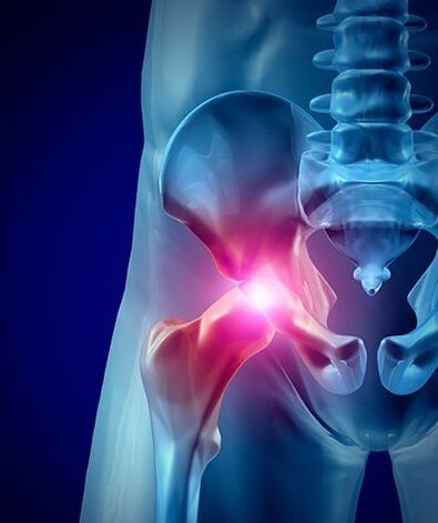 foto de dor no quadril 1