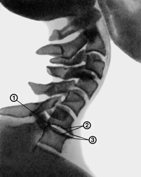 Radiografia da coluna cervical com osteocondrose