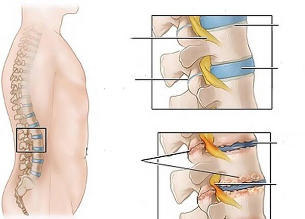 alterações nos discos devido à osteocondrose