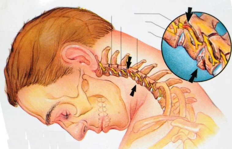 sintomas de osteocondrose cervical