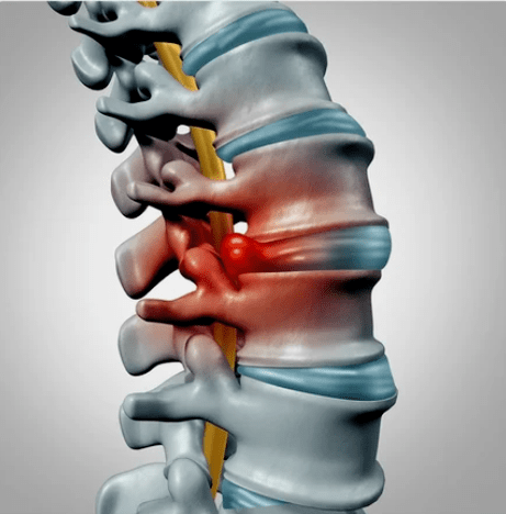 Protecência dos discos intervertebrais
